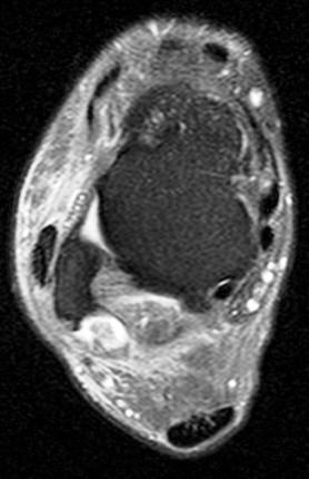 Figure 2 for case peroneal dislocation